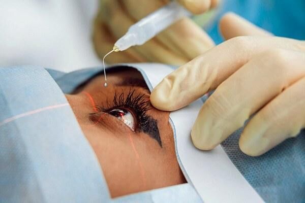 Cataract Surgery